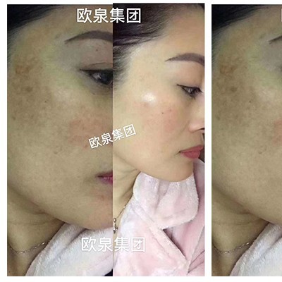 理性認(rèn)識和使用祛斑靚膚類化妝品